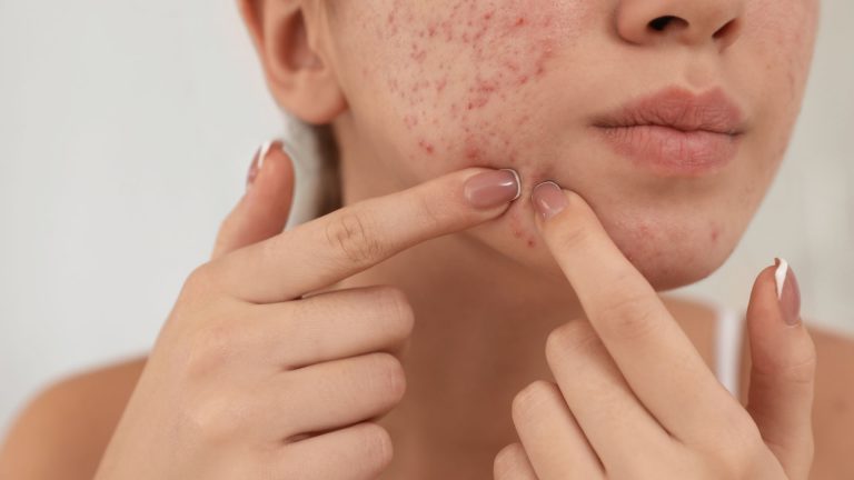 The Ultimate Guide to Acne Facials in Pickering
